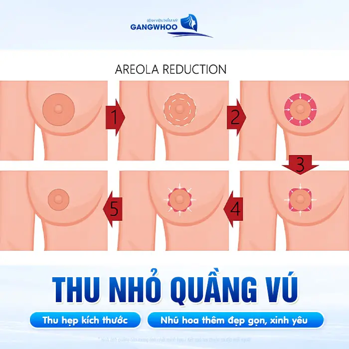 Thu Nhỏ Quầng Vú Hai Bên Cho Bầu Ngực Thêm Xinh Đẹp Hồng Hào