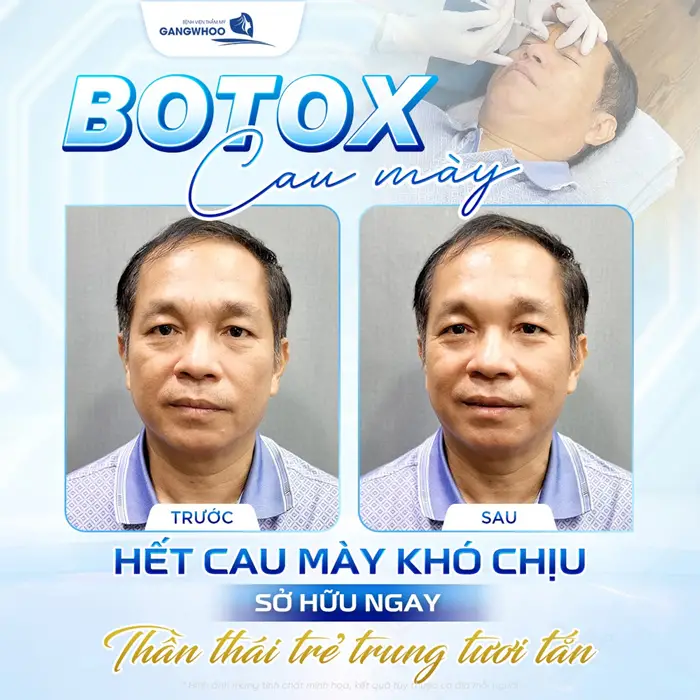 Botox xóa cơ cau màu hết cau mày khó chịu sở hữu ngay thần thái trẻ trung và tươi tắn