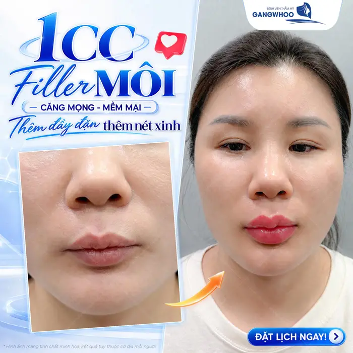 Thẩm Mỹ Trẻ Hóa Môi - Cho Đôi Môi Căng Mọng Quyến Rũ 6 Tiêm 1 CC Filler môi đường nét thêm đầy đặn, đôi môi thêm căng tràn bừng nét xinh