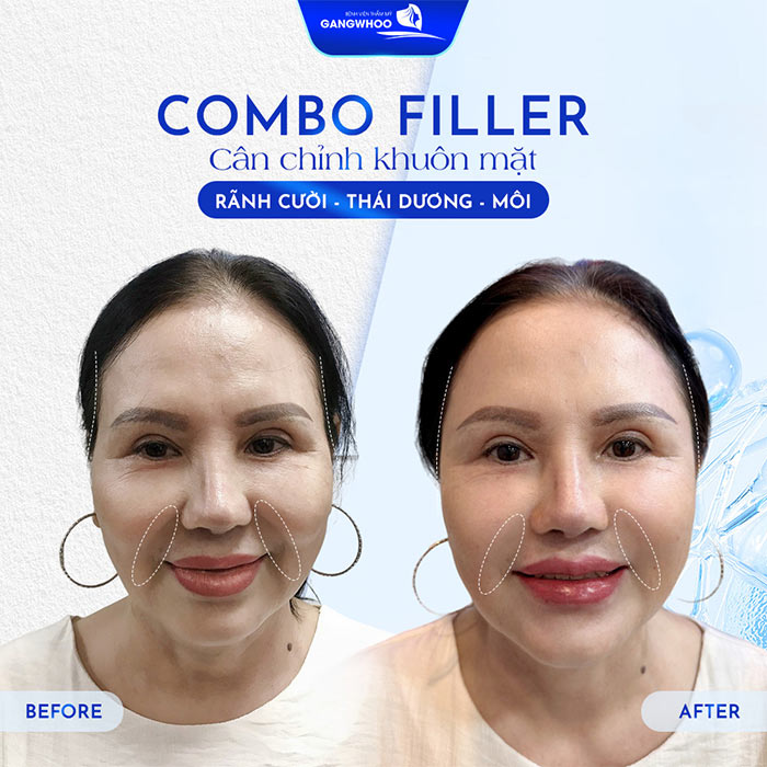 Độn Thái Dương Sở Hữu Gương Mặt Thanh Tú Đầy Sức Sống 7 Khuôn mặt hài hòa, cân đối sau khi cân chỉnh thái dương tại bệnh viện thẩm mỹ Gangwhoo