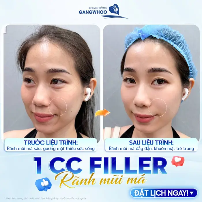 Tiêm Filler rãnh mũi má sau liệu trình rãnh mũi má đầy đặn, khuôn mặt thêm trẻ trung và đầy tươi tắn
