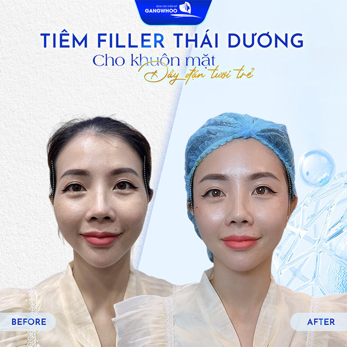 Độn Thái Dương Sở Hữu Gương Mặt Thanh Tú Đầy Sức Sống 6 Sở hữu diện mạo đầy đặn, tươi trẻ cho khách hàng sau tiêm thái dương