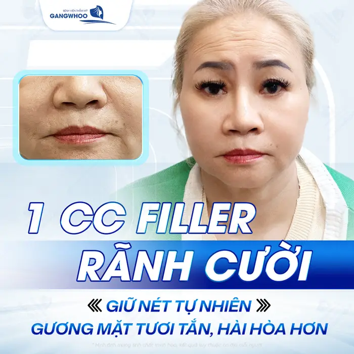 Xóa Rãnh Mũi Má An Toàn, Không Phẫu Thuật, Ít Tốn Kém 4 Tiêm 1 CC Filler rãnh cười giữ nét tự nhiên, gương mặt tươi tắn và hài hòa hơn