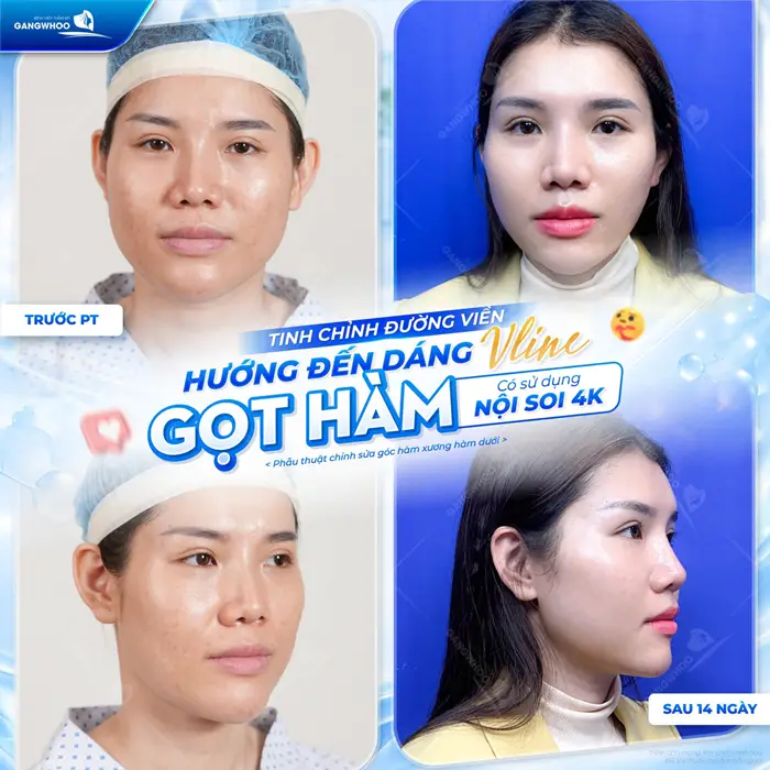 Tinh chỉnh đường viền hướng dẫn dáng V Line sau gọt hàm có sử dụng nội soi 4K