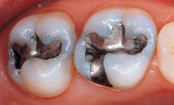 Trám răng bằng Amalgam