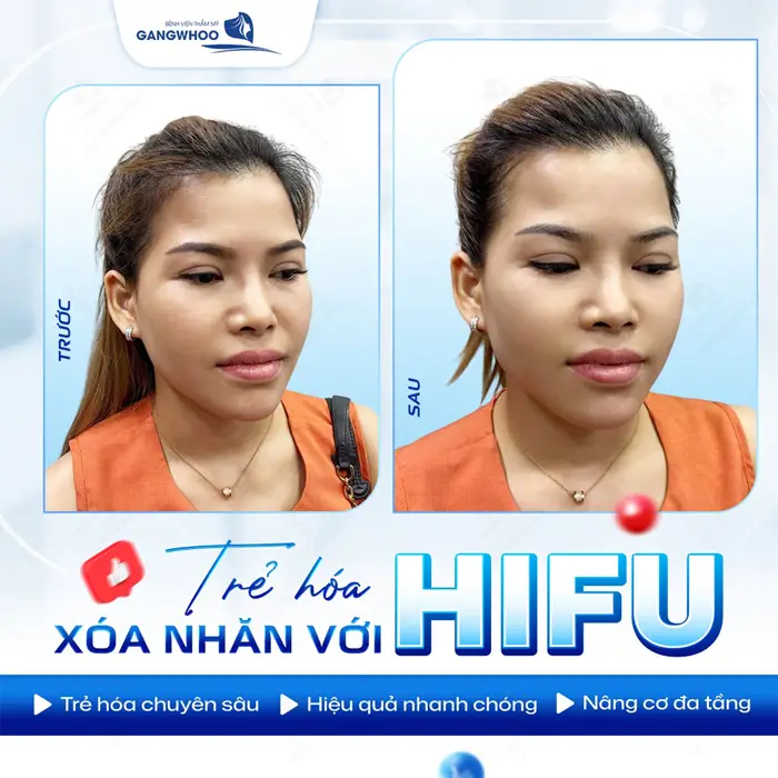 Trẻ hóa xóa nhăn với Hifu trẻ hóa chuyên sâu, hiệu quả nhanh và nâng cơ đa tầng