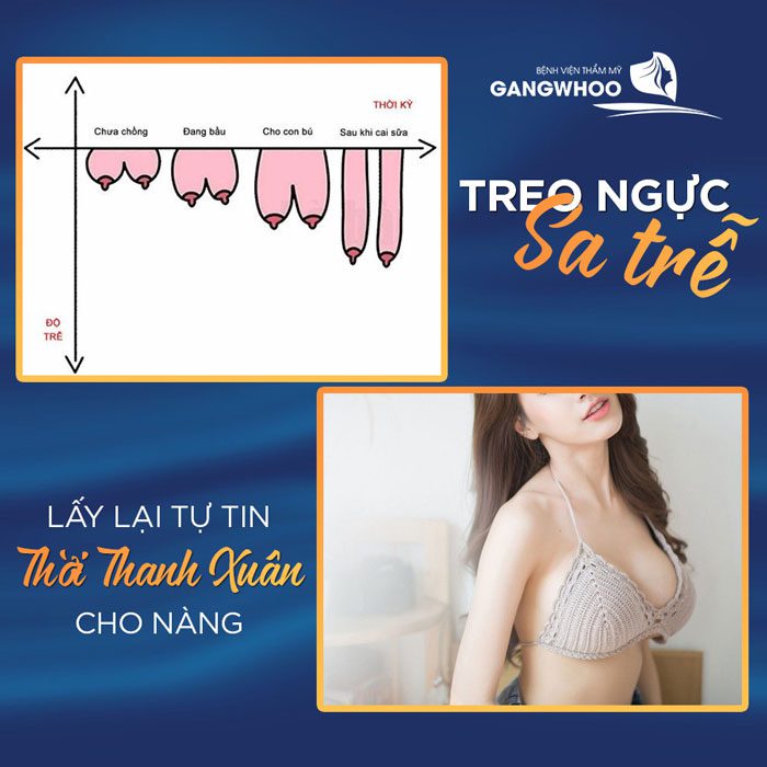 Giá treo ngực sa trễ là: 45,000,000đ - 65,000,000đ tùy tình trạng chảy xệ.