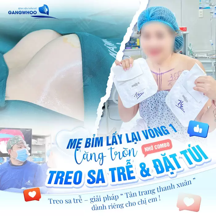 Treo Ngực Sa Trễ Nội Soi 4K Khắc Phục Mọi Cấp Độ Sa Trễ 3 Treo sa trễn và đặt túi giải pháp hoàn hảo giúp mẹ bỉm lấy lại vòng 1 căng tròn
