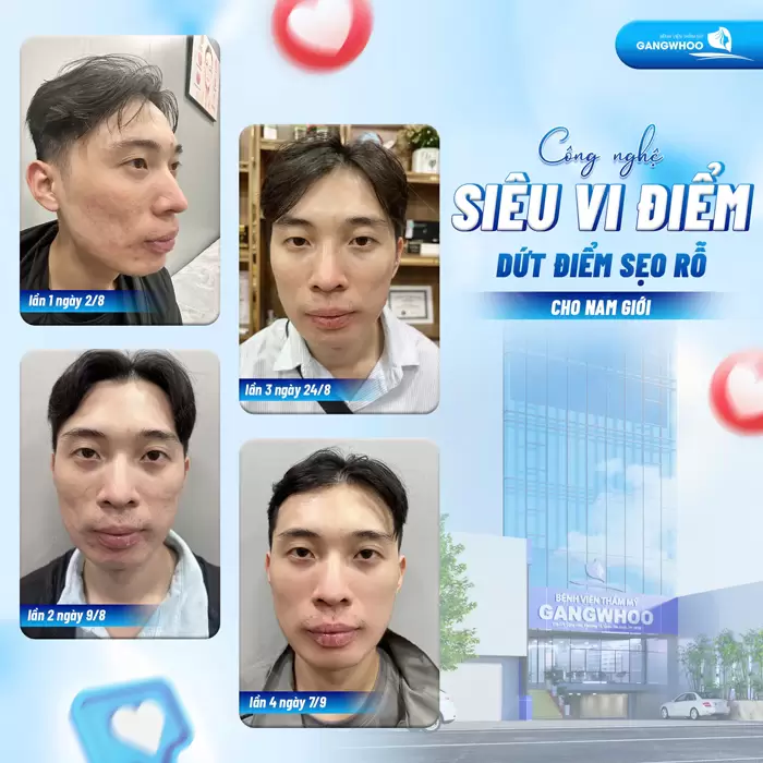 Trị sẹo rỗ siêu vi điểm cải thiện diện mạo, nâng tầm nhan sắc đẹp tự tin trở lại