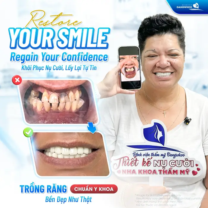 Trồng răng chuẩn y khoa răng bền đẹp như thật khôi phục nụ cười lấy lại sự tự tin