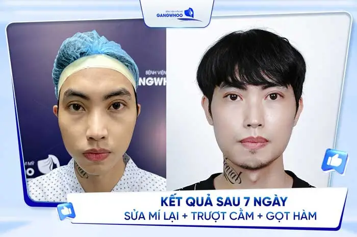 Trượt Cằm V-Line Nội Soi 4K - Quy Trình Và Những Lưu Ý 15 Kết quả sau 7 ngày trượt cằm của Hot Tiktoker