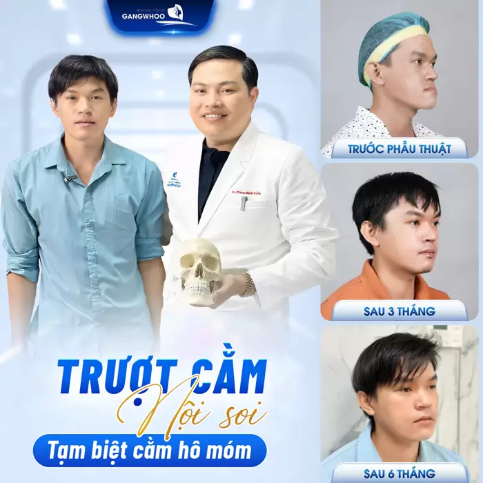 Trượt Cằm V-Line Nội Soi 4K - Quy Trình Và Những Lưu Ý 14 truot cam noi soi dieu chinh cam ho mom hieu qua