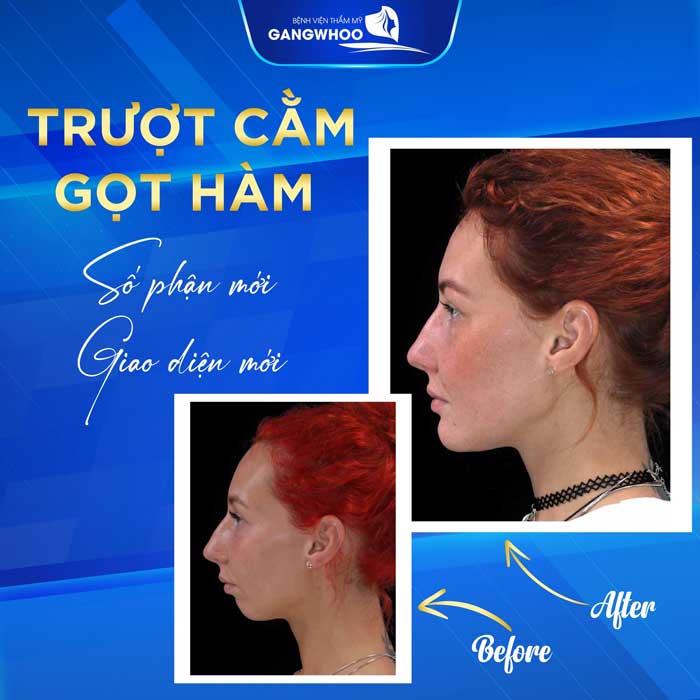 truot cam