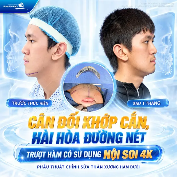 Trượt Cằm V-Line Nội Soi 4K - Quy Trình Và Những Lưu Ý 1 Cân đối khớp cắn hài hòa đường nét trượt hàm có sử dụng nội soi 4K