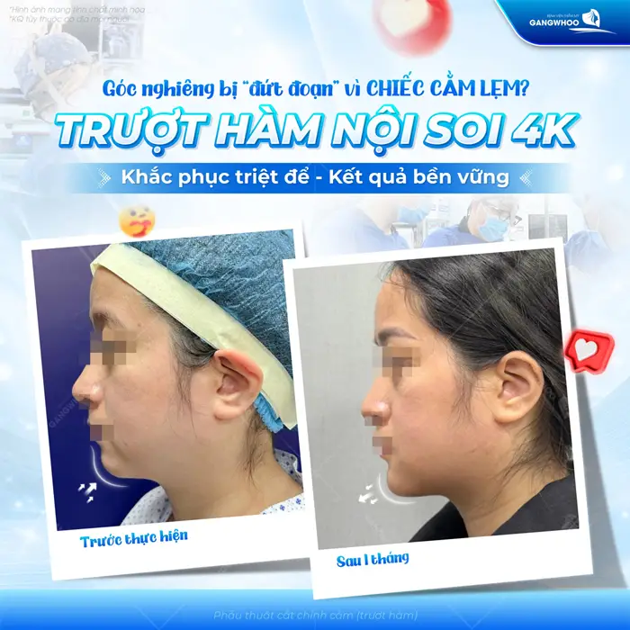Góc nghiêng đẹp xuất sắc sau 1 tháng trượt hàm nội soi 4K tự tin khoe nhan sắc và diện mạo đẹp đầy thăng hạng và cuốn hút