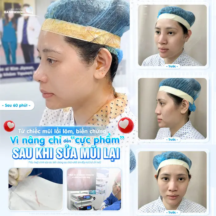 Từ chiếc mũi lồi lõm, biến chứng vì nâng chỉ giờ sửa lại đẹp cực phẩm với diện mạo hài hòa và thăng hạng hơn thấy rõ