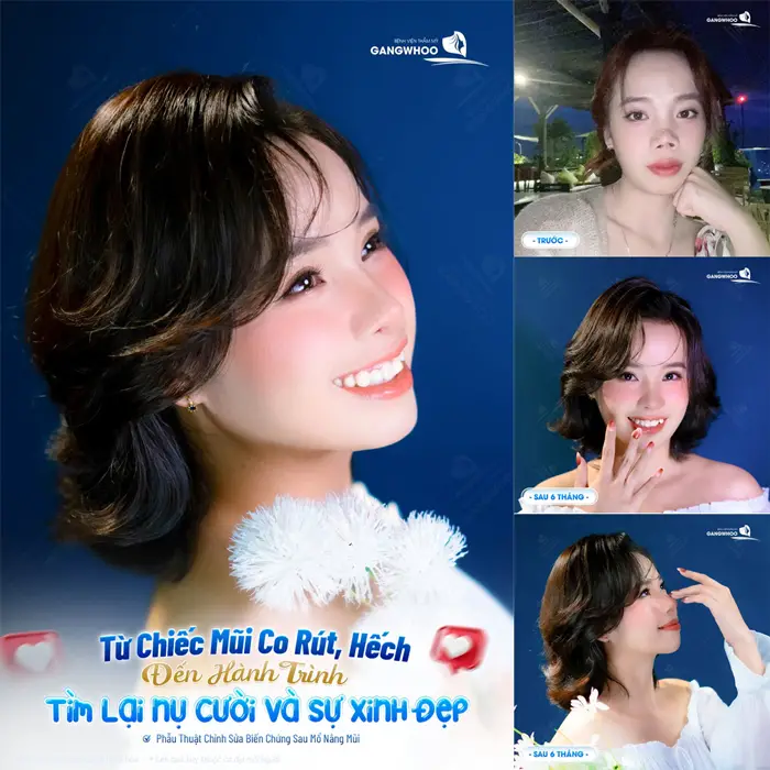 Top 5 Bệnh Viện Sửa Mũi Hỏng Hàng Đầu Tại TPHCM 3 Từ chiếc mũi co rút, hếch đến hành trình tìm lại nụ cười đầy xinh đẹp và rạng rỡ sau khi sửa mũi lại