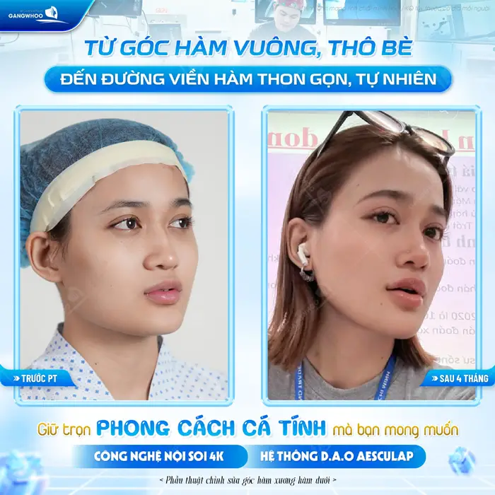 Từ góc hàm vuông, thô bè đến đường viền hàm thon gọn, tự nhiên giữ trọn phong cách cá tính mà bạn mong muốn
