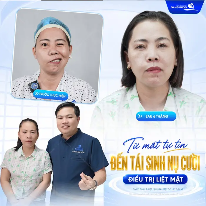 Từ gương mặt mất tự tin đến tái sinh nụ cười sau điều trị liệt mặt tại BVTM Gangwhoo