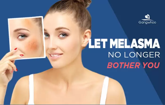 Ultra YEG Melasma Treatment - Say Goodbye To Melasma 3 ultra yeg melasma 1