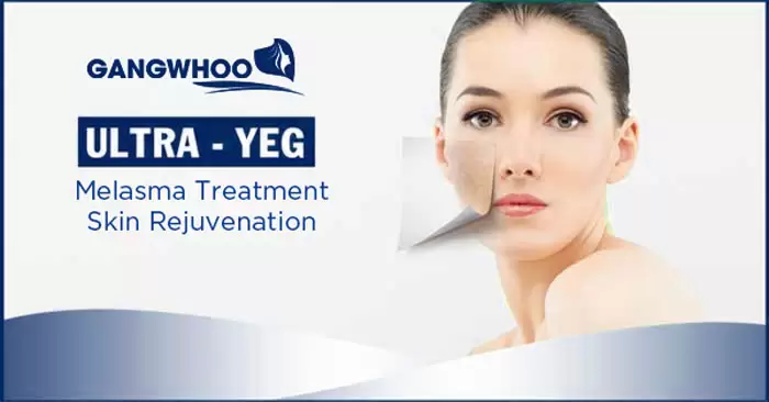 Ultra YEG Melasma Treatment - Say Goodbye To Melasma 1 ultra yeg melasma 2