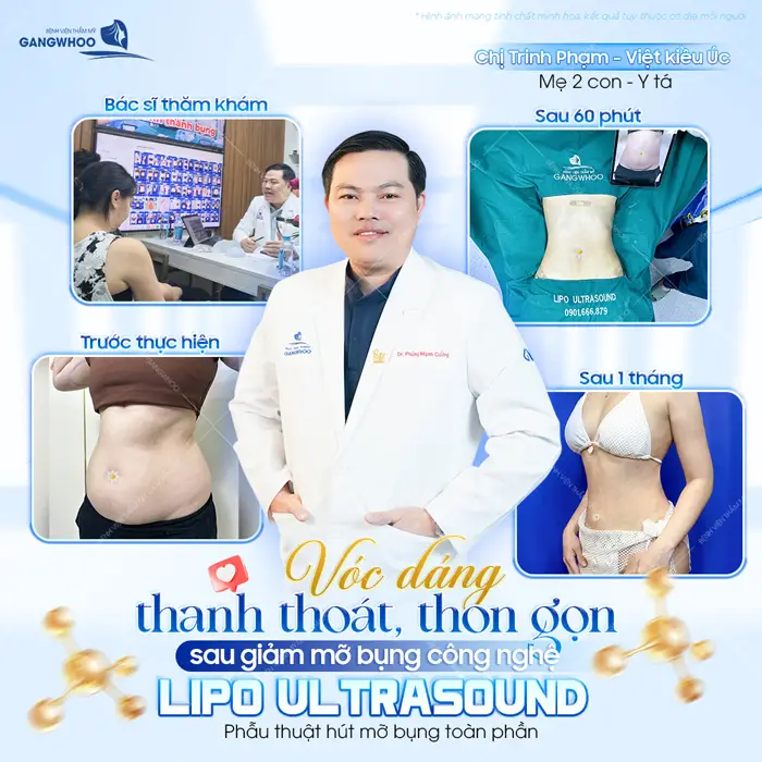 Vóc dáng thanh thoát, thon gọn sau giảm mỡ bụng công nghệ Lipo Ultrasound