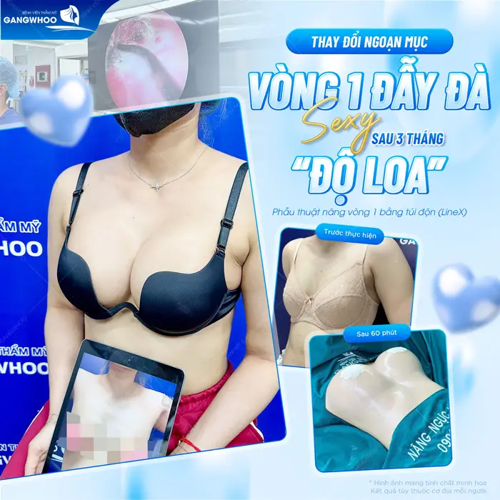 Phẫu Thuật Nội Soi Nâng Ngực (Nâng Ngực Nội Soi Túi Nano Không Chip) "CHUẨN TỰ NHIÊN" 4 Thay đổi ngoạn mục vòng 1 đẹp đầy đã sau 3 tháng đã đẹp xuất sắc và đầy cuốn hút