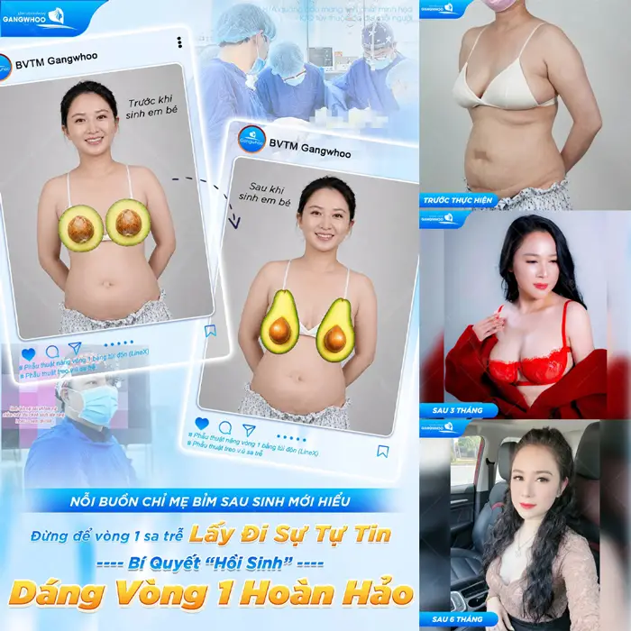 Từ vòng 1 sa trễ kém tự tin đến vòng 1 căng tràn hoàn hảo sau treo sa trễ tại bệnh viện thẩm mỹ Gangwhoo 