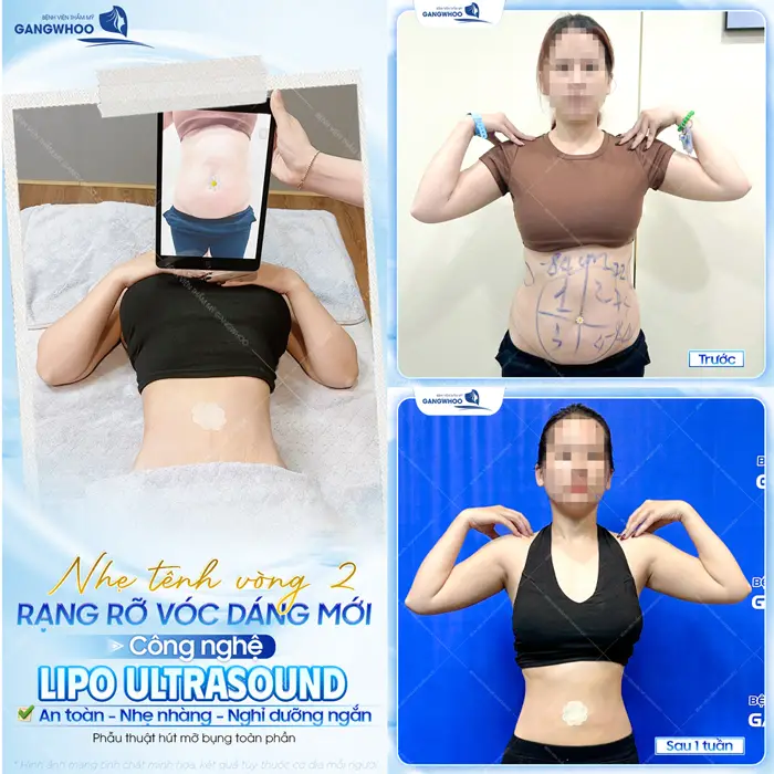 Nhẹ nhàng vòng 2 rạng rỡ đón vóc dáng mới với công nghệ Lipo Ultrasound hiện đại