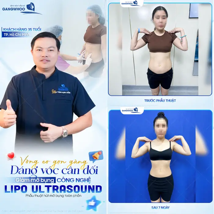Vòng eo gọn gàng dáng vóc đan đối sau giảm mỡ bụng công nghệ Lipo Ultrasound hiện đại 