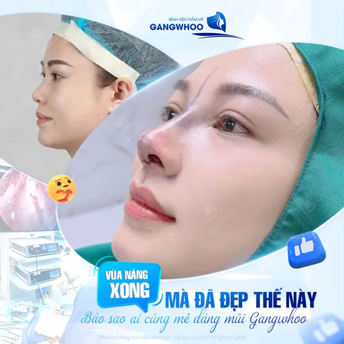 Vừa nâng mũi xong góc nghiêng đã xuất sắc như thế này bảo sao không mê cho được