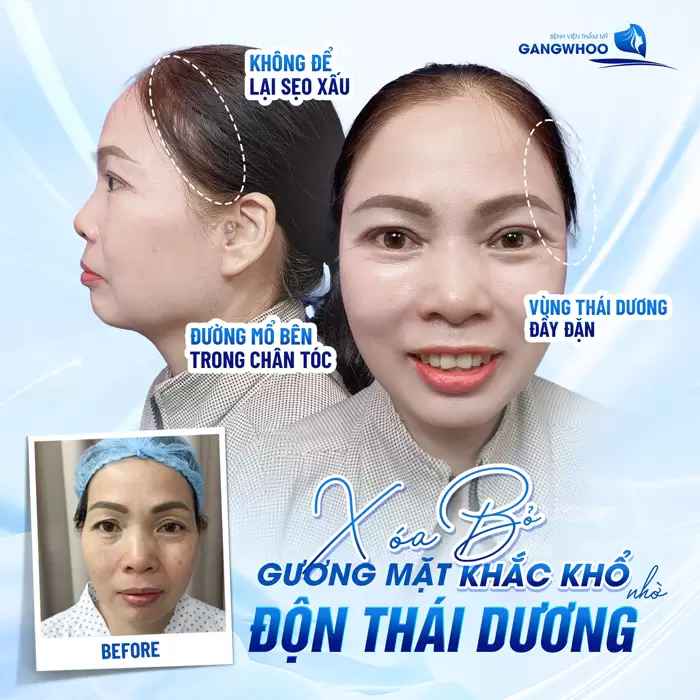 Độn Thái Dương Sở Hữu Gương Mặt Thanh Tú Đầy Sức Sống 2 Độn thái dương là giải pháp lý tưởng giúp xóa bỏ gương mặt khắc khổ an toàn, không để lại sẹo
