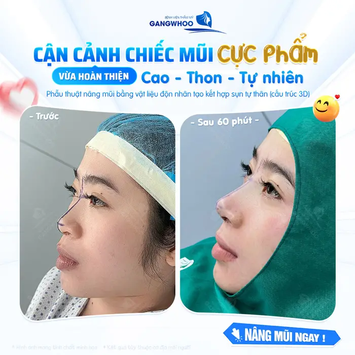 Cận cảnh chiếc mũi cực phầm vừa hoàn thiện cao đẹp, thon gọn mà vẫn vô cùng tụ nhiên tại BVTM Gangwhoo