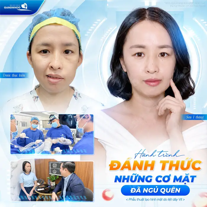 Chi Phí Điều Trị Liệt Mặt Là Bao Nhiêu? Bảng Giá Mới 2025 10 Hành trình đánh thức những cơ mặt đã ngủ quên sau điều trị liệt mặt tại bệnh viện thẩm mỹ Gangwhoo