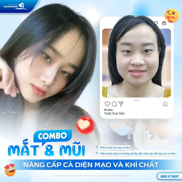 Nâng mũi và cắt mí cùng lúc nâng cấp cả diện mạo và nâng tầm khí chất cho khuôn mặt