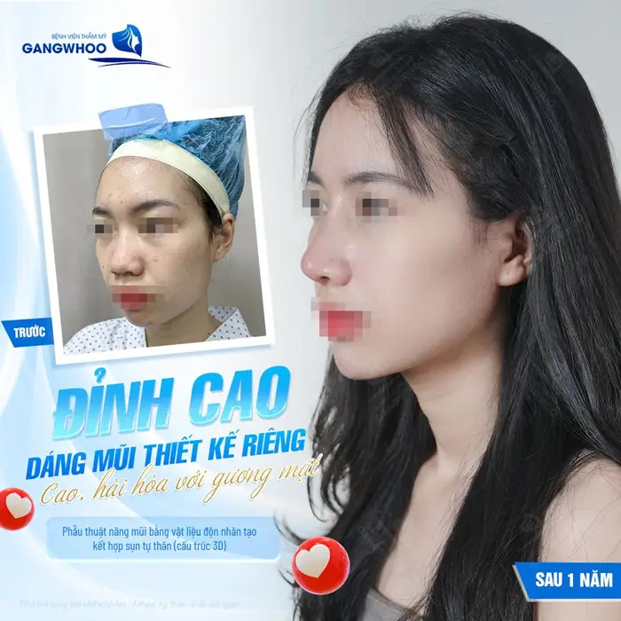 Nâng Mũi Bọc Sụn Có Vĩnh Viễn Không? Cách Duy Trì Lâu Dài 6 Đỉnh cao dáng mũi thiết kế riêng đó là sự đẹp hài hòa với gương mặt thêm nhuận sắc