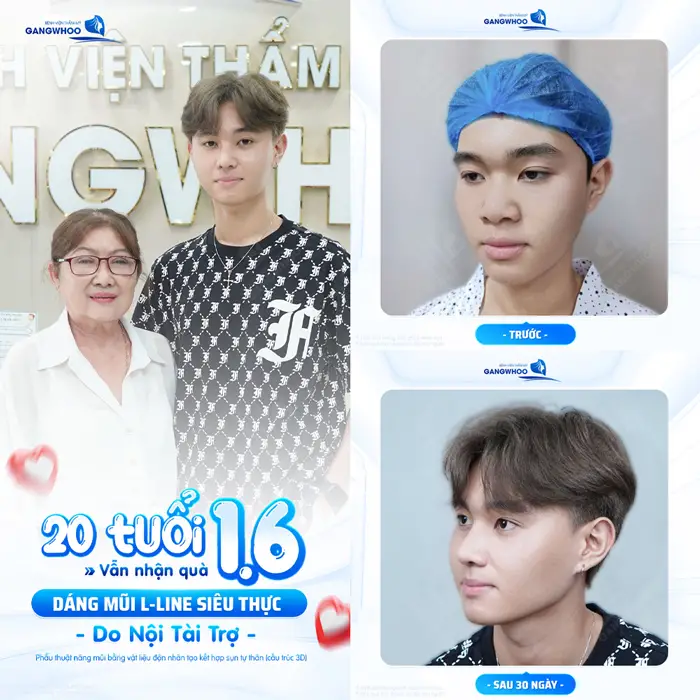 Dáng mũi L Line đẹp siêu thực do bà nội tài trợ kết quả sau 30 ngày đẹp trai hết nấc
