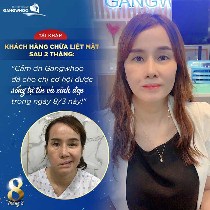 Image of our customer before & after 2 months of facial palsy treatment at Gangwhoo Cosmetic Hospital