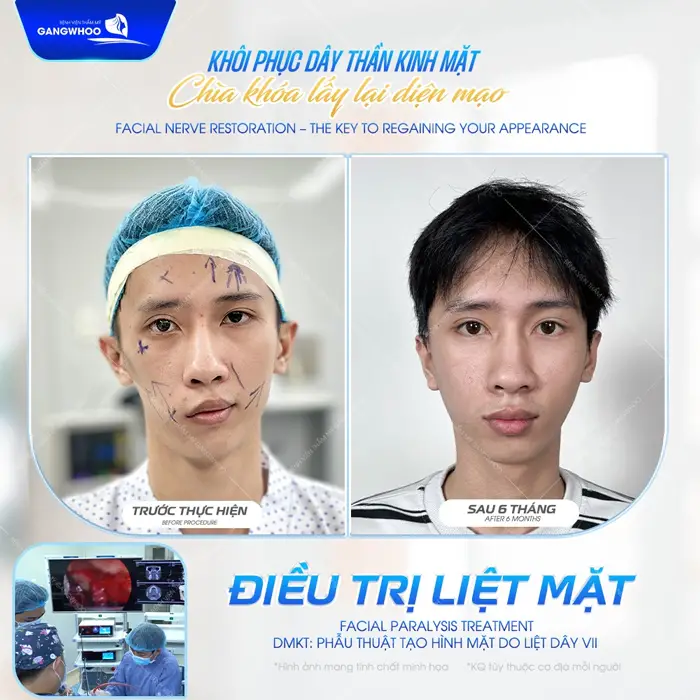 Khôi phục dây thần kinh mặt chìa khóa lấy lại diện mạo sau 6 tháng đã cân đối hoàn toàn 