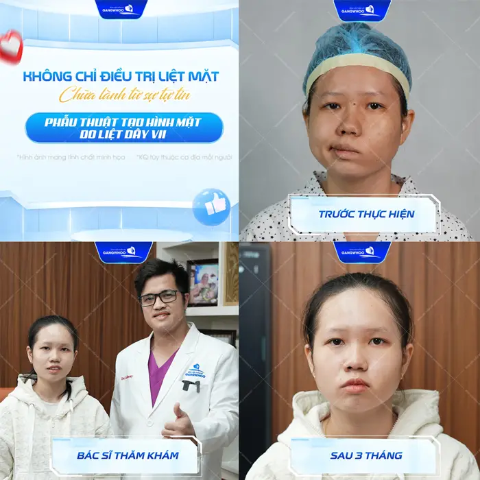 Điều trị liệt mặt chữa lành từ sự tự tin với khuôn mặt được cân chỉnh cân đối và hài hòa hơn thấy rõ