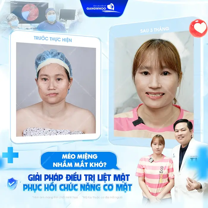 Méo miệng, nhắm mắt khó cũng không còn là nỗi lo với giải pháp điều trị liệt mặt phục hồi chức năng cơ mặt hiệu quả