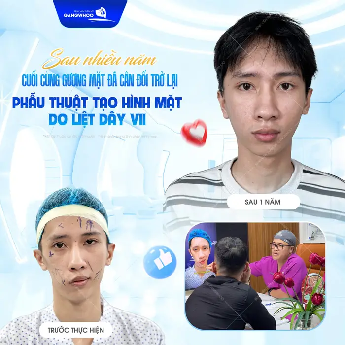 Sau nhiều năm khắc phục tình trạng liệt mặt gương mặt đã đẹp cân đối trở lại 