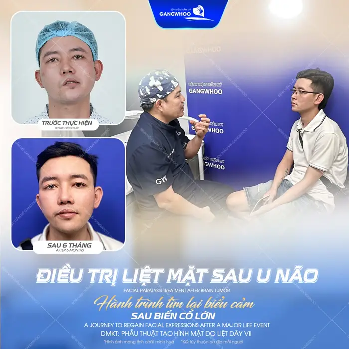 Điều trị liệt mặt sau u não hành trình tìm lại biểm cảm sau biến cố lớn khách hàng đã hoàn toàn tự tin hơn từng ngày sau tái khám