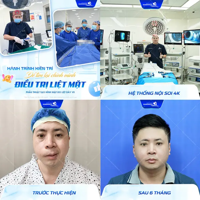 Liệt Dây Thần Kinh Số 7 Nguy Hiểm Không? Triệu Chứng Và Điều Trị 1 Hành trình kiên trì để tìm lại chính mình điều trị liệt mặt với sự hỗ trợ của công nghệ nội soi 4K mặt cân đối và hài hòa hơn