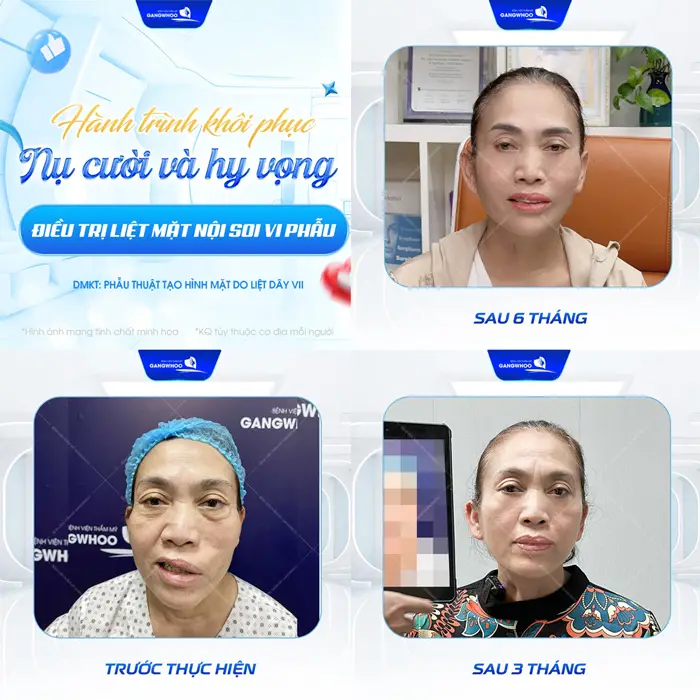 Hành trình khôi phục nụ cười và hy vọng sau điều trị liệt mặt nội soi vi phẫu gương mặt trở nên cân đối hơn từng ngày