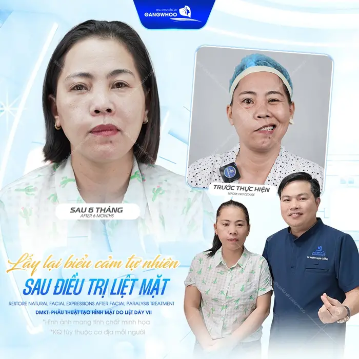 Lấy lại biểm cảm tự nhiên sau điều trị liệt mặt gương mặt thêm cân đối và hài hòa hơn sau 6 tháng đã khác biệt hoàn toàn