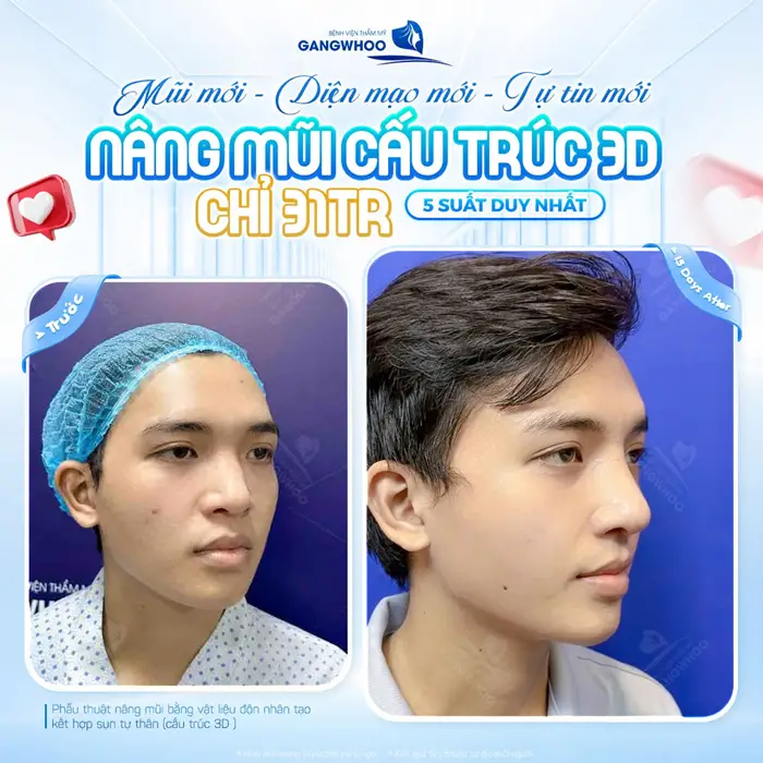 Nâng cấp diện mạo với dáng mũi mới đẹp thăng hạng và tôn lên đường nét điển trai sau phẫu thuật 