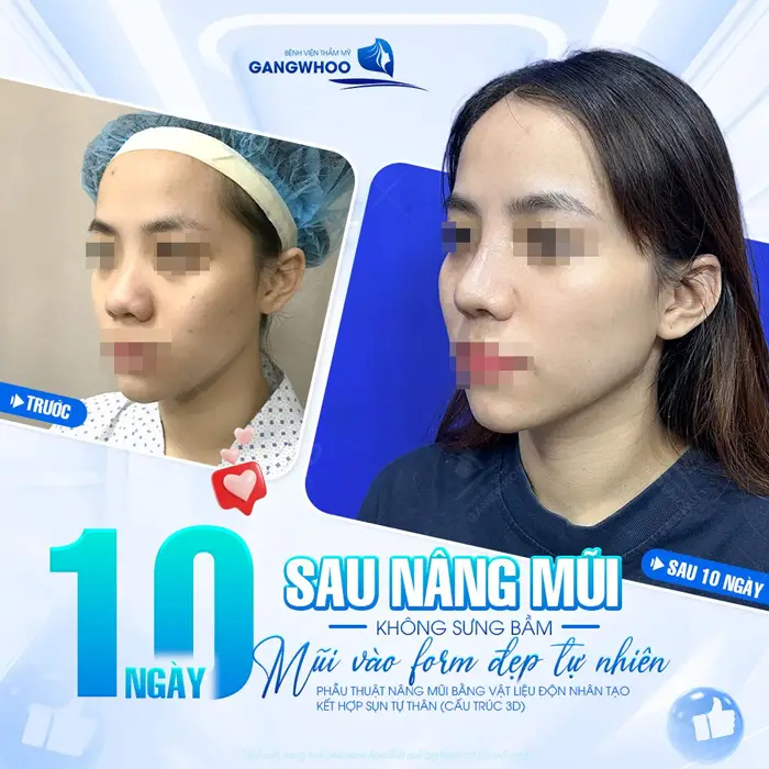 10 ngày sau nâng mũi không sưng bầm mũi vào form đẹp chuẩn tự nhiên và hài hòa 