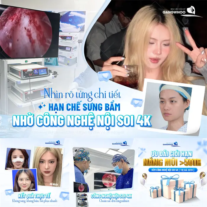 Nhìn rõ từng chi tiết hạn chế sưn gbầm nhờ công nghệ nội soi vi 4K mũi cao đẹp và nhanh hồi phục