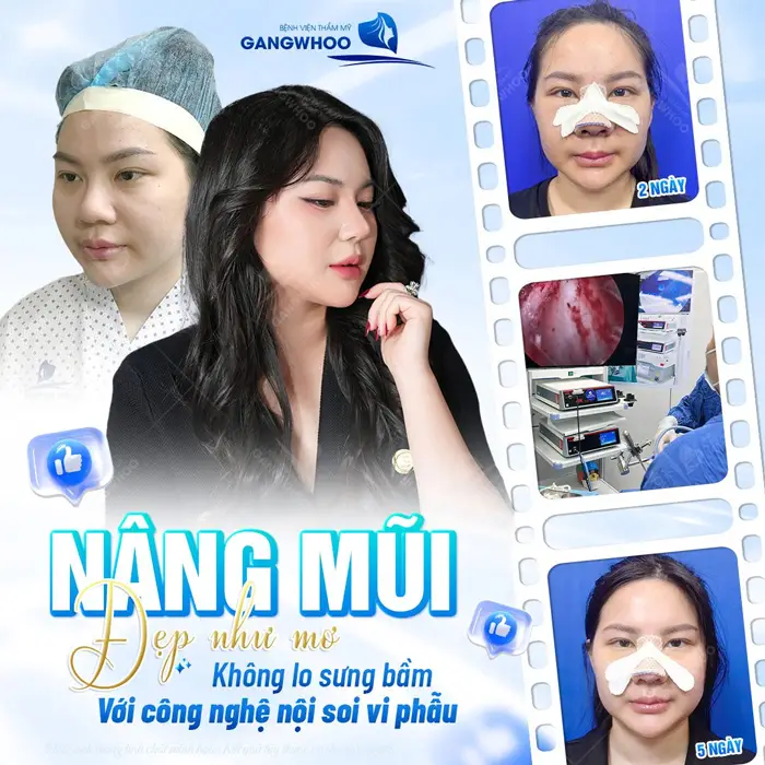 Nâng mũi xong đẹp như mơ không lo sưng bầm với công nghệ nội soi vi phẫu hiện đại 